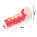 MODELO KINGDEN 1/4 DE ARCADA 3ER MOLAR IMPACTADO INF