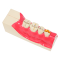 MODELO KINGDEN 1/4 DE ARCADA 3ER MOLAR IMPACTADO INF