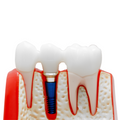 MODELO DIDACTICO KINGDEN IMPLANTOLOGIA Y PROTESIS