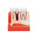 MODELO DIDACTICO KINGDEN IMPLANTOLOGIA Y PROTESIS