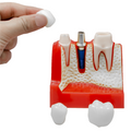 MODELO DIDACTICO KINGDEN IMPLANTOLOGIA Y PROTESIS
