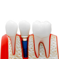 MODELO DIDACTICO KINGDEN IMPLANTOLOGIA Y PROTESIS