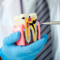 MODELO DENTAL KINGDEN CARIES S/PATOLOGIAS