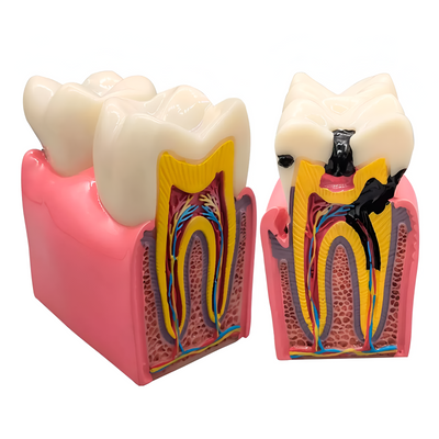 MODELO DENTAL KINGDEN CARIES S/PATOLOGIAS