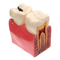 MODELO DENTAL KINGDEN CARIES S/PATOLOGIAS